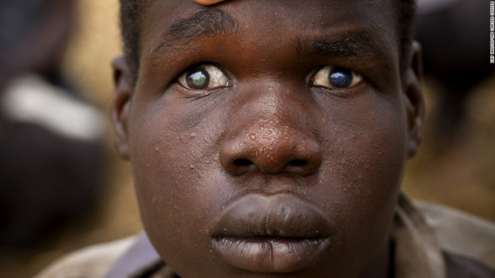 A victim of River Blindness. Photo credit: cdn.dailypost.ng