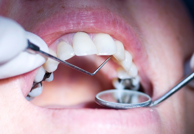 Dental amalgam 